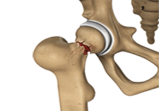 Hip Injury