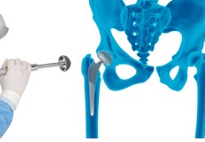 MAKO<sup>®</sup> Robotic Anterior Hip Replacement